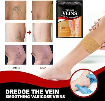 Parches para varices